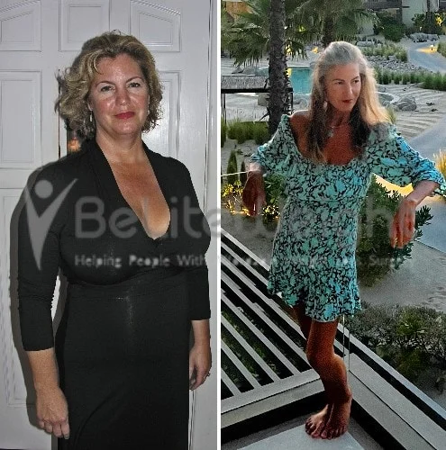 RNY Gastric Bypass Before and After Catalina - 4 Year Update*